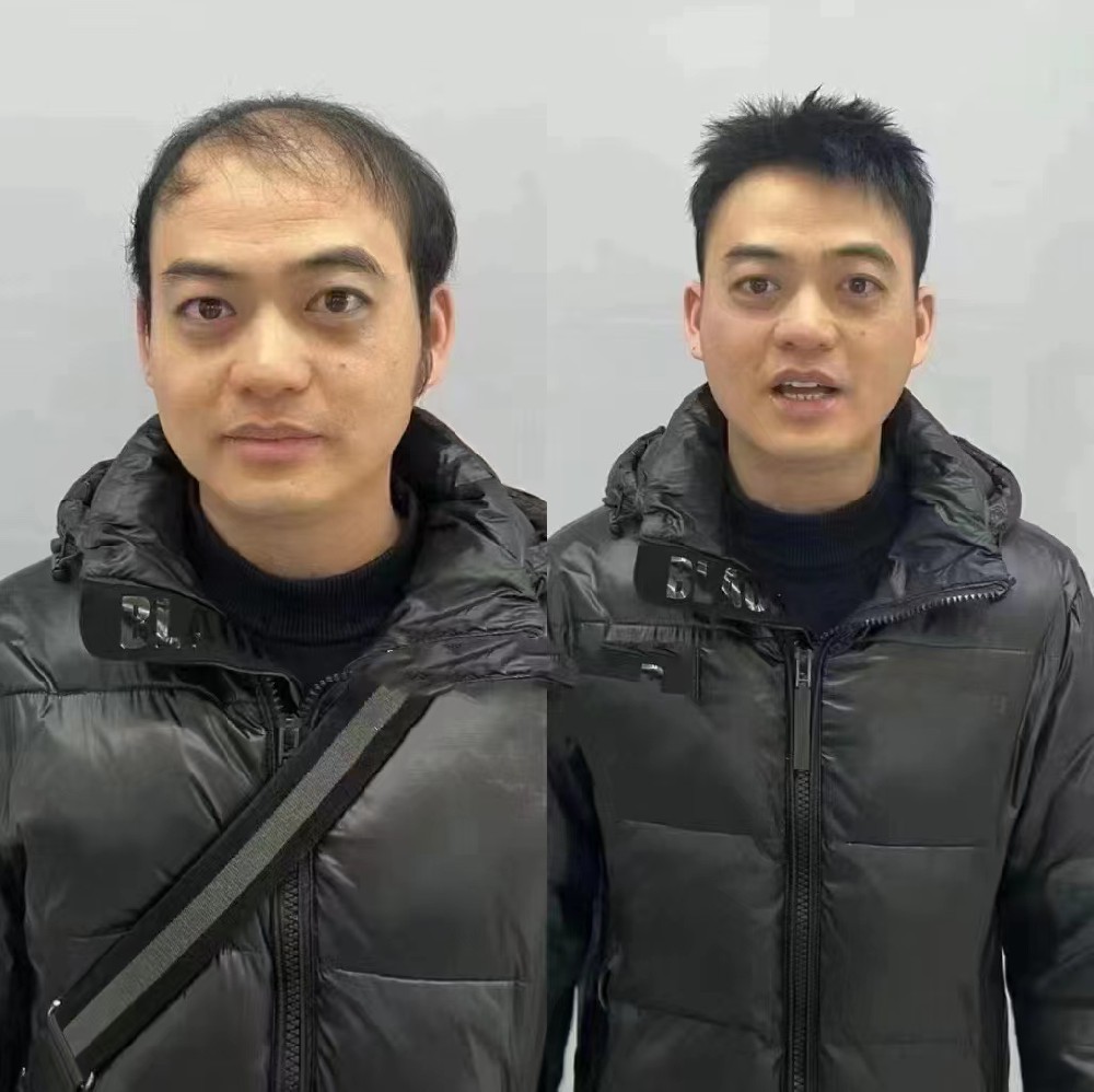 脱发油腻大叔变身帅哥，他很感谢南阳千丝美补发假发定制