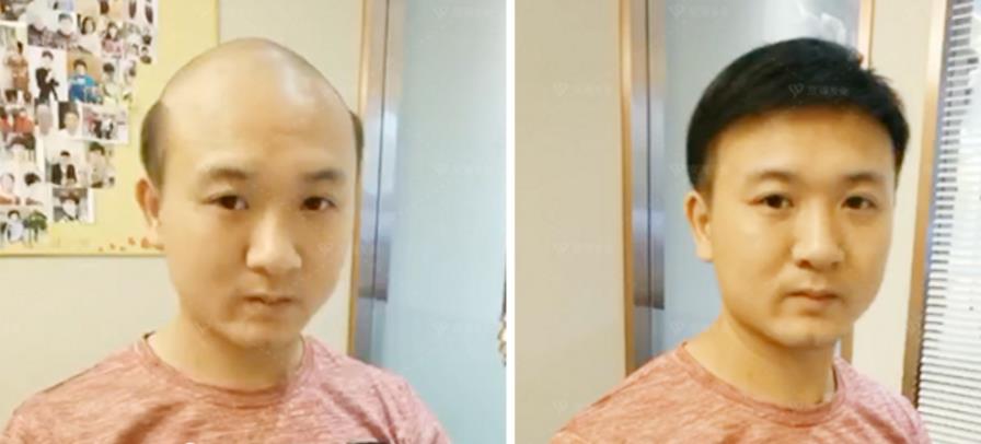 男性脱发是什么原因引起的，能治好吗？