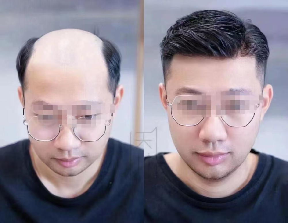 “在南阳千丝美定制假发后，老婆夸我年轻了不止一轮！”一位脱发男士的真实蜕变故事