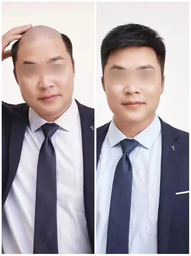 南阳假发定制，头发改造，彻底拯救男人谢顶形象