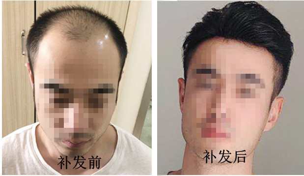 南阳假发定制：发型重塑人生，千丝美助力脱发人群重拾自信