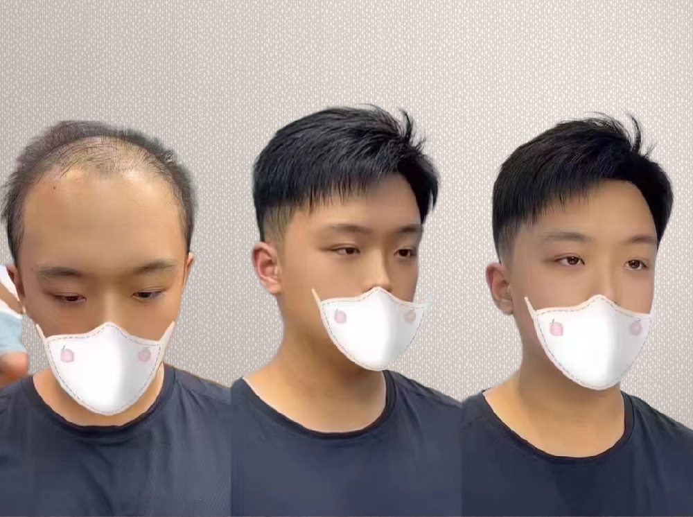 南阳中老年人头发稀疏解决方案：千丝美补发假发定制让您重回年轻态