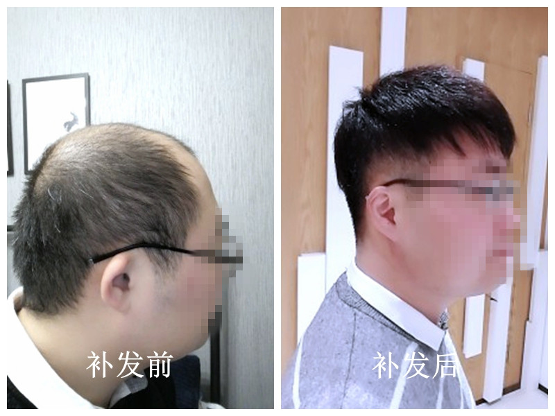 南阳假发太逼真了！直击发友增发后的真实改变