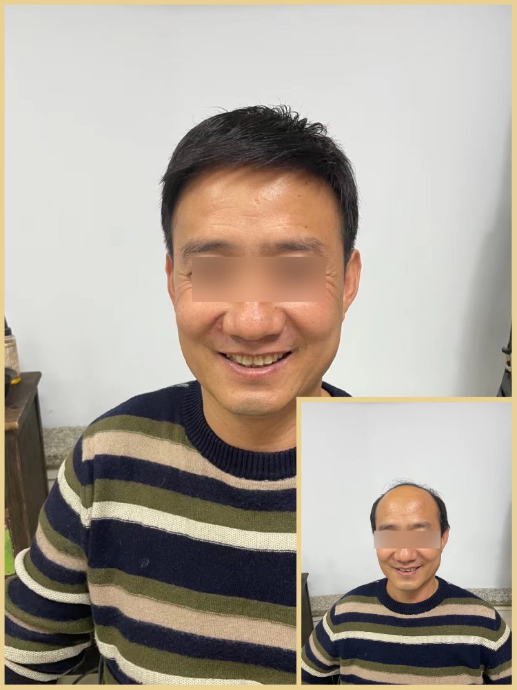 南阳千丝美假发定制：轻松解决秃顶困扰，找回年轻自信