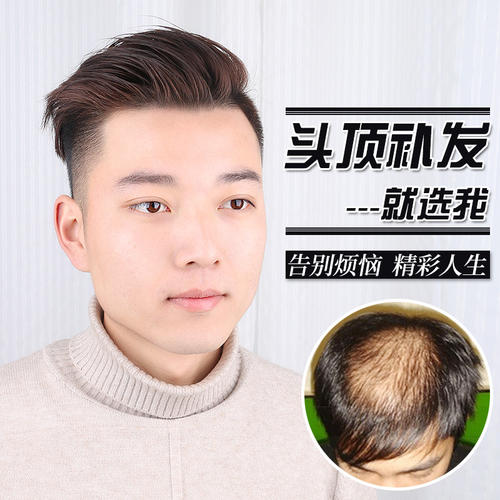 头发稀少怎么办？这里有你需要的解决方案