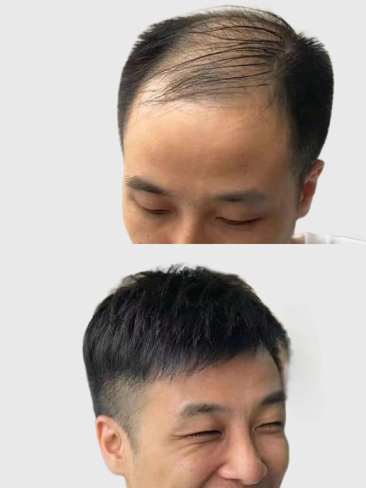 面对头发稀疏，我们可以做些什么