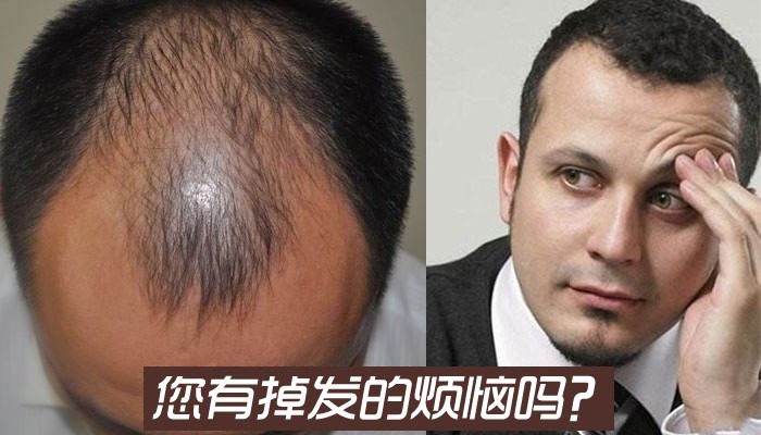 揭密掉发严重怎么办？看这里