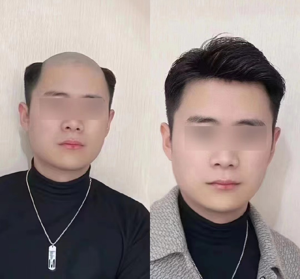 一顶假发，改变人生