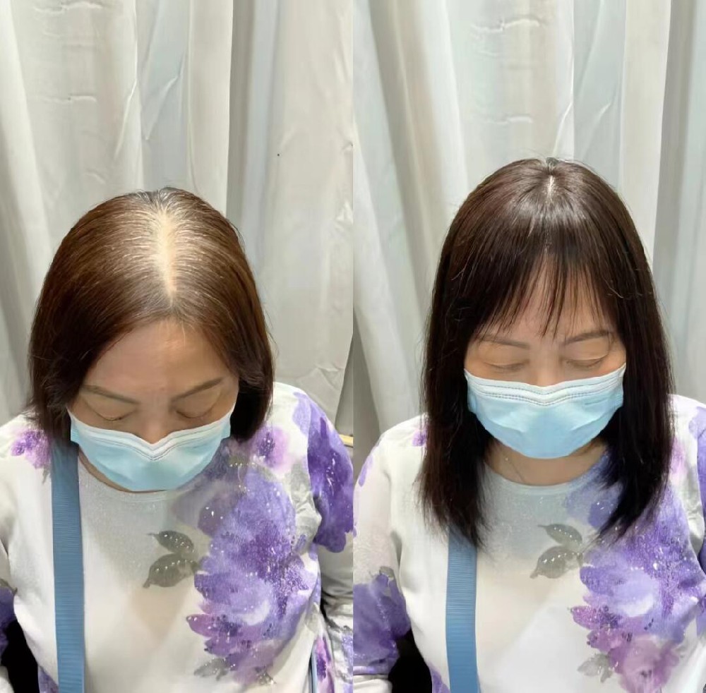 头发稀疏困扰多？南阳专业补发定制服务介绍