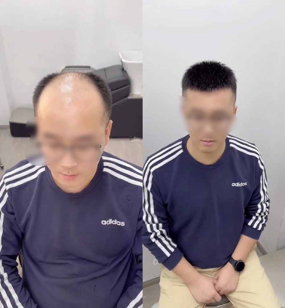 在南阳，头发稀疏和疤痕脱发到底该怎么办？