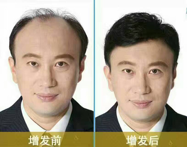 南阳脱发困扰者：了解原因比急着尝试更重要