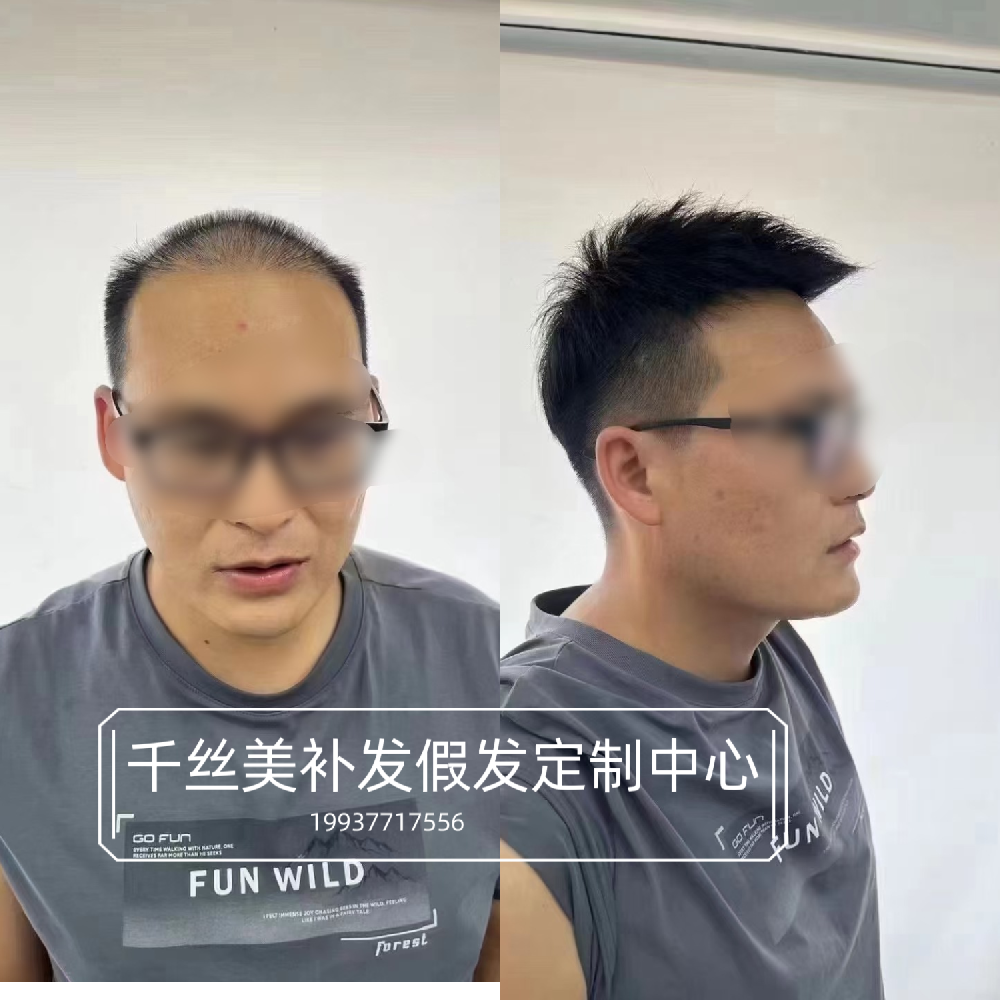 南阳千丝美补发假发定制中心：专业为您解决脱发烦恼