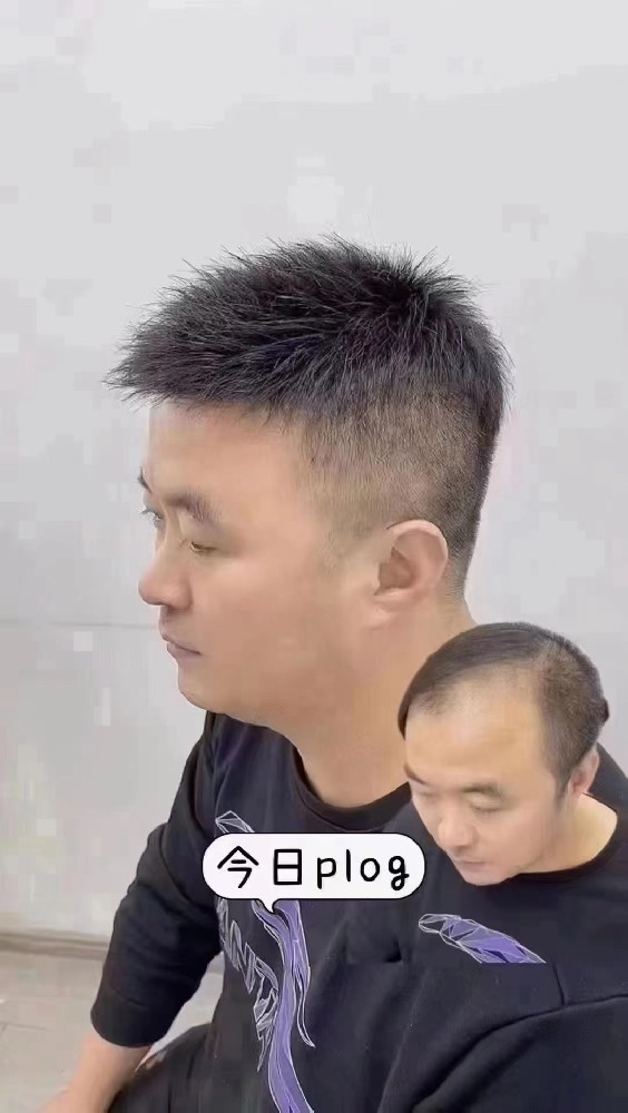南阳假发定制千丝美补发助您遗传性秃发困扰