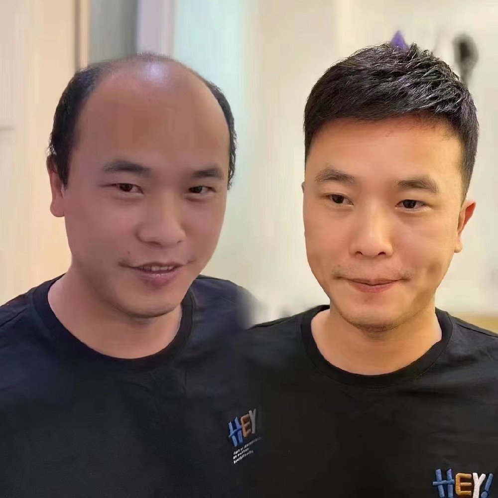 南阳假发定制：如何选择既自然又舒适的局部补发方案？