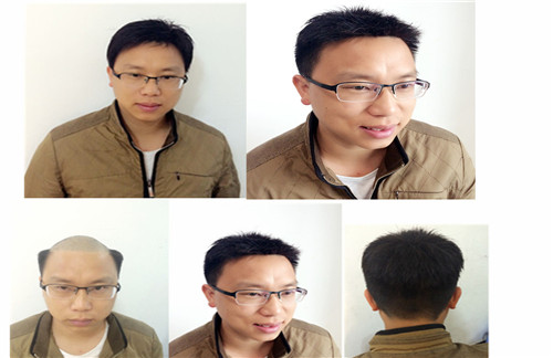 不同脱发症状对应什么？南阳假发定制千丝美_男女补发更省心