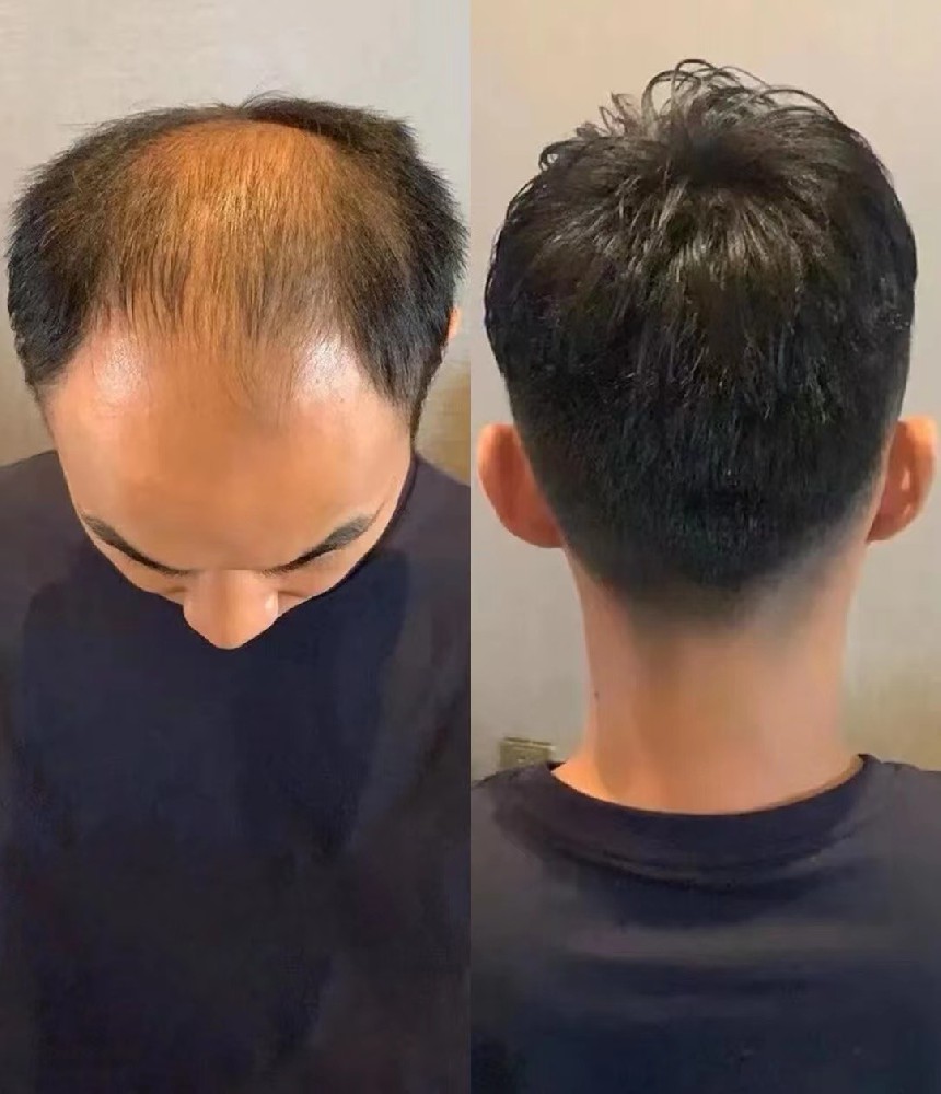 南阳千丝美补发假发定制：重拾自信，绽放光彩