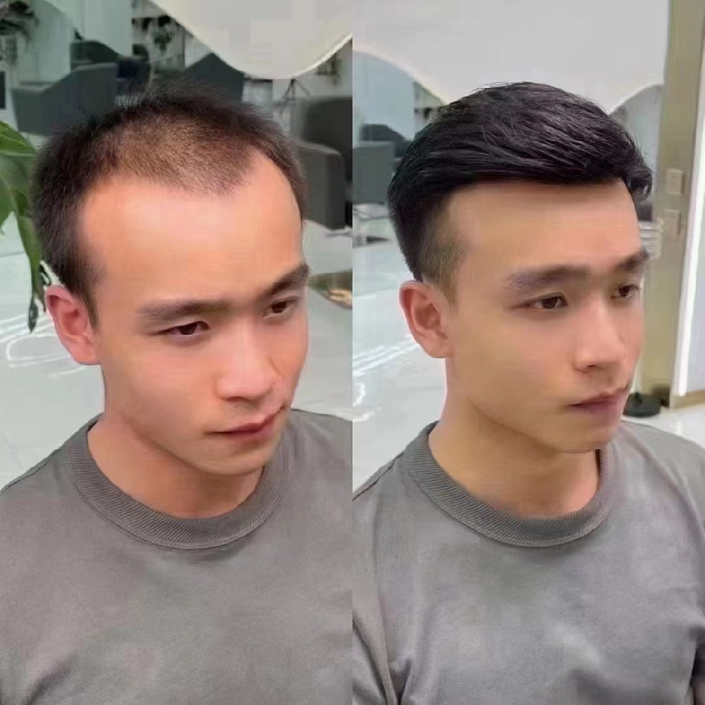 重拾自信，千丝美定制假发让我焕发新生
