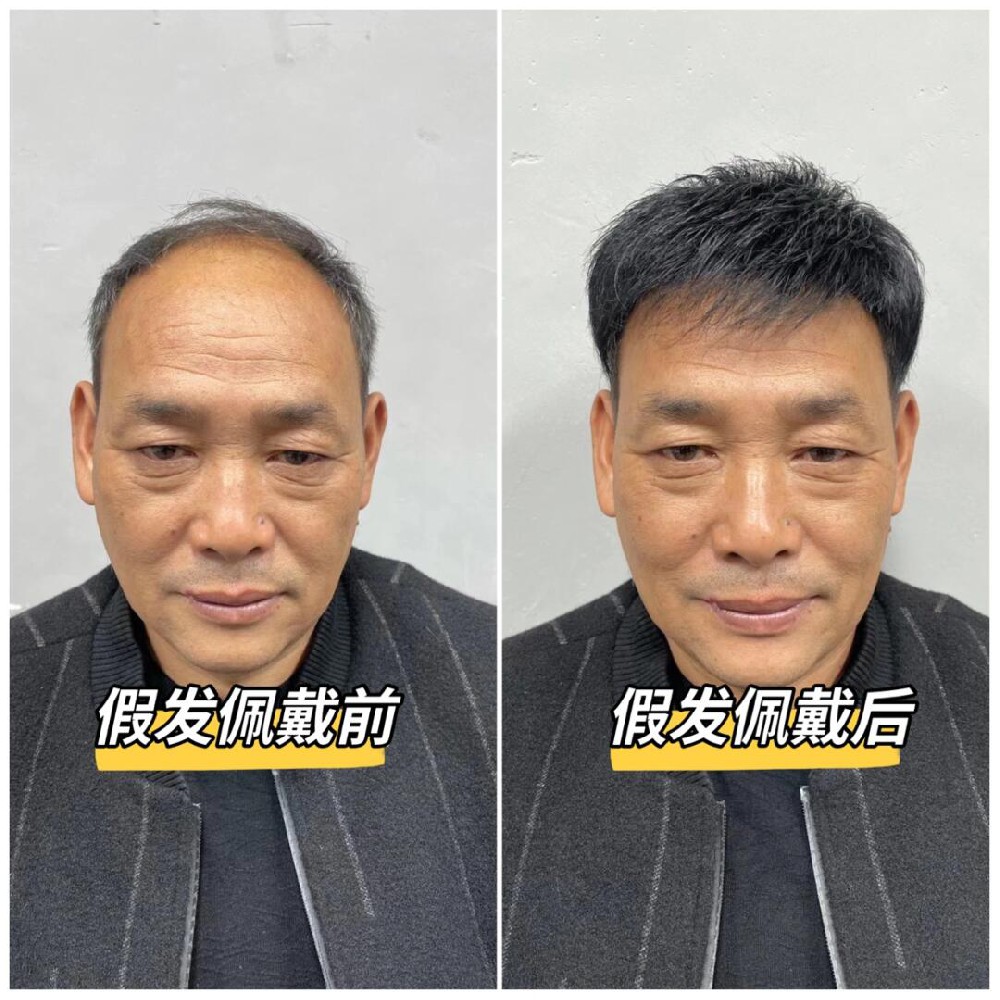 南阳脂溢性脱发不用愁，推荐千丝美补发假发定制中心