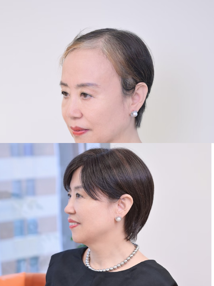 告别脱发尴尬：为什么越来越多的南阳人选择“无痕补发”？