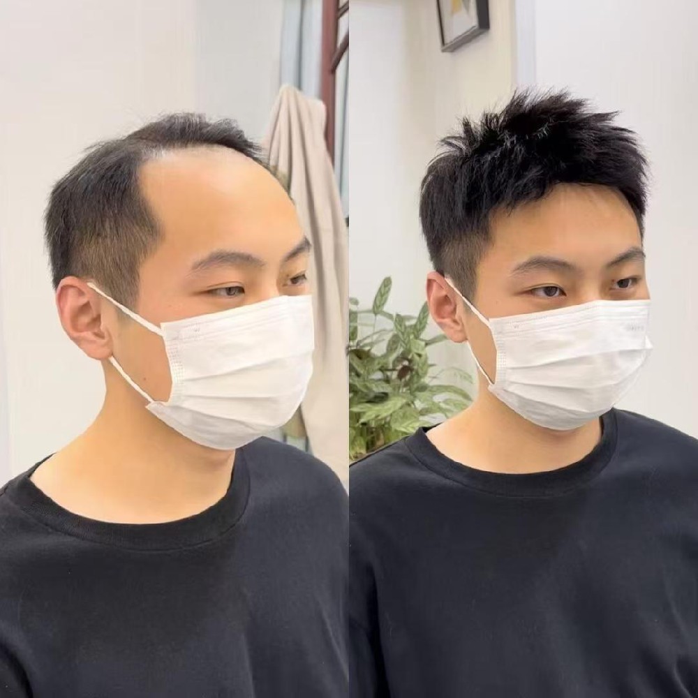 南阳小伙因脱发屡遭挫败？换个思路解决形象问题，推荐南阳千丝美补发假发定制中心