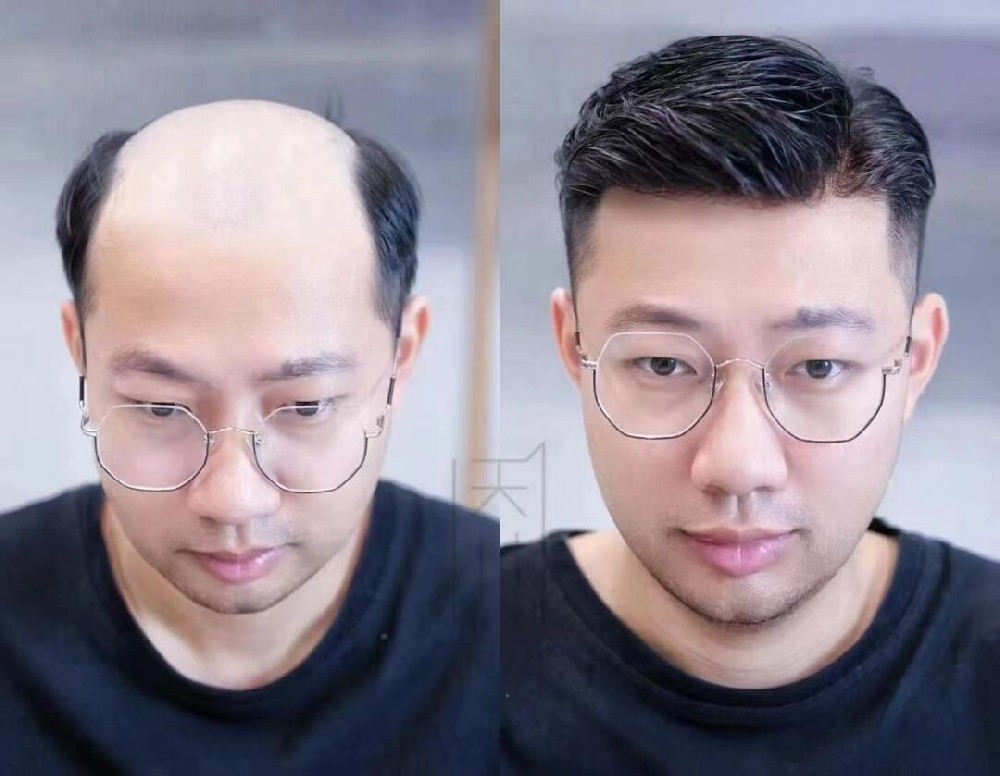 南阳假发定制指南：从儿童斑秃到成人脱发，找寻适合各年龄段的解决方案