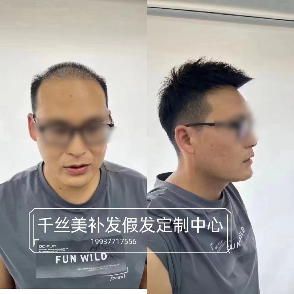 南阳假发定制指南:告别脱发与稀疏烦恼,重拾年轻自信 南阳假发定制指南:告别脱发与稀疏烦恼,重拾年轻自信