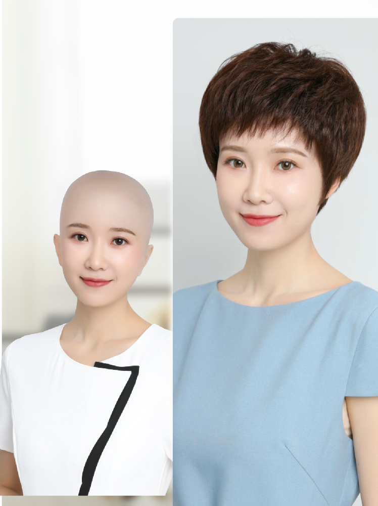 南阳大额头、额头稀发怎么修饰？南阳假发补发定制自然改脸型