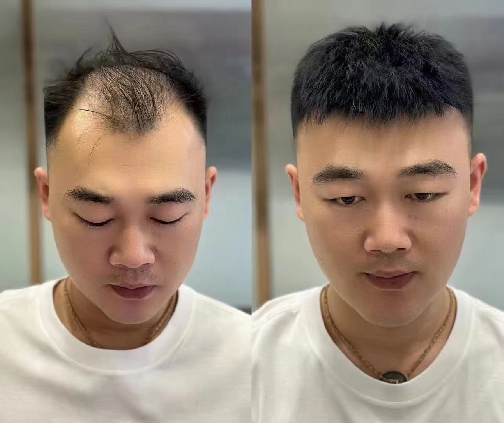 南阳脱发尽早干预!无创物理增发技术,安全解决稀疏谢顶白发问题  用户qekui2 今天修改 南阳脱发尽早干预!无创物理增发技术,安全解决稀疏谢顶白发问题  用户qekui2 今天修改