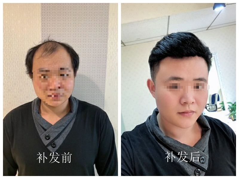 南阳白发脱发不用愁,本地假发定制帮普通人改善形象 南阳白发脱发不用愁,本地假发定制帮普通人改善形象