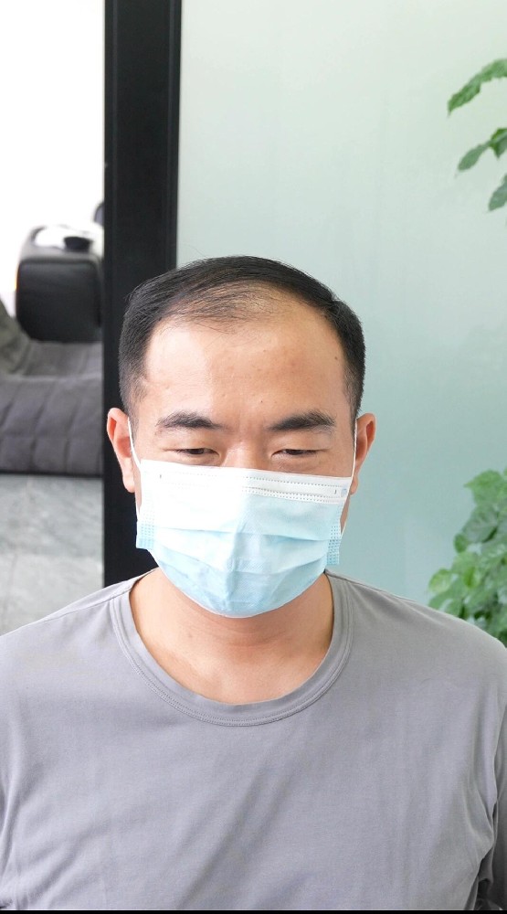 做假发之前和之后，一个南阳脱发者的两天对比