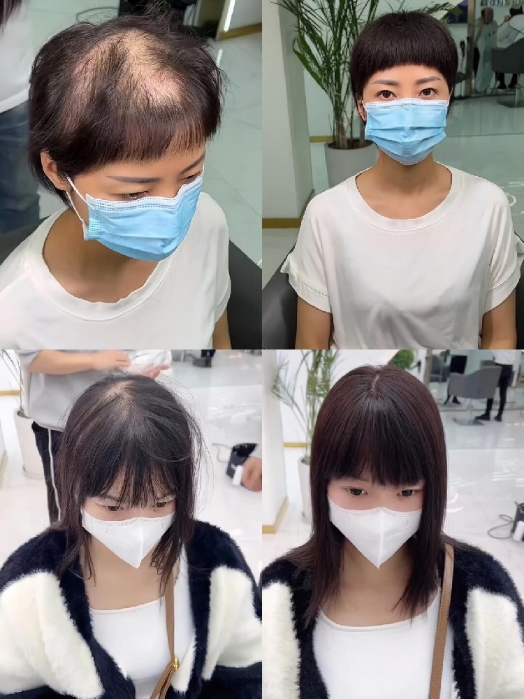 白头发能不能拔、能不能根治?南阳千丝美说说白发那些事 白头发能不能拔、能不能根治?南阳千丝美说说白发那些事