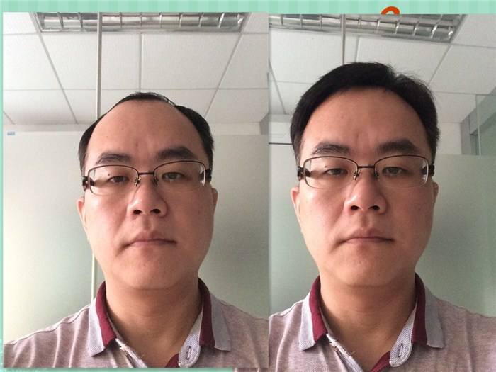 南阳人买假发如何避坑？手把手教你选对“无感又逼真”的定制发